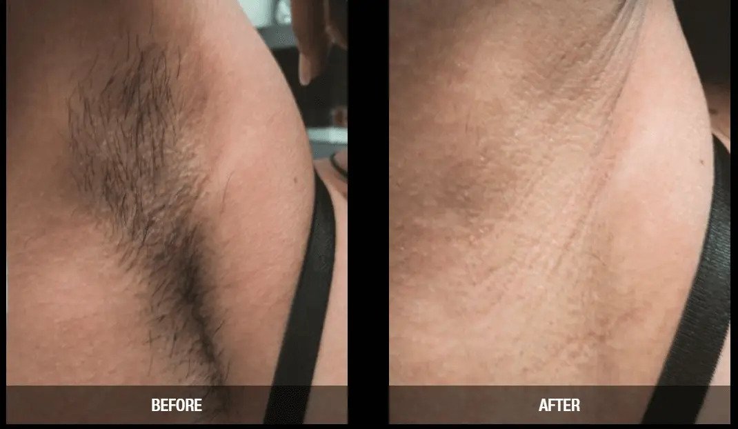 Laser hair removal results