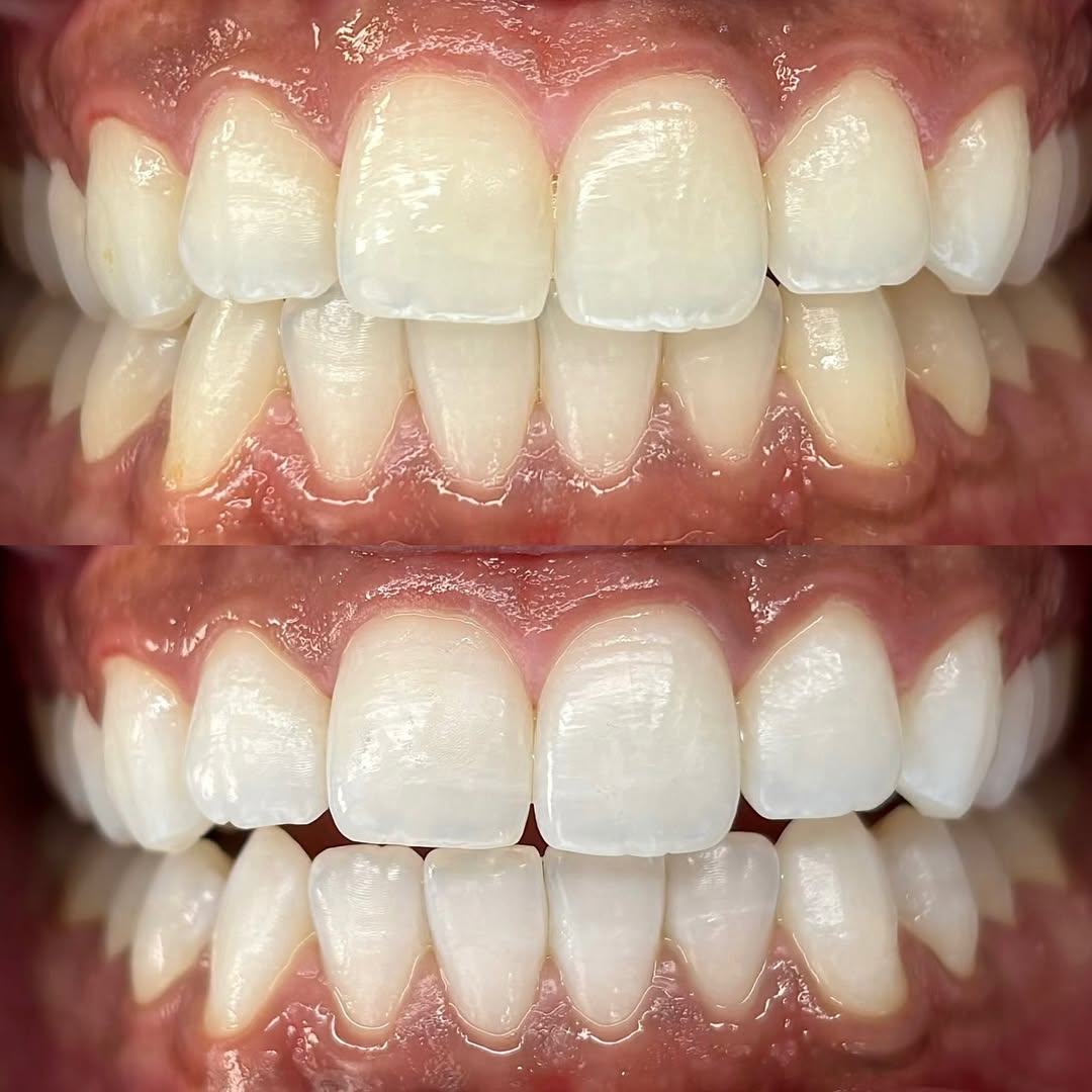 Teeth whitening results