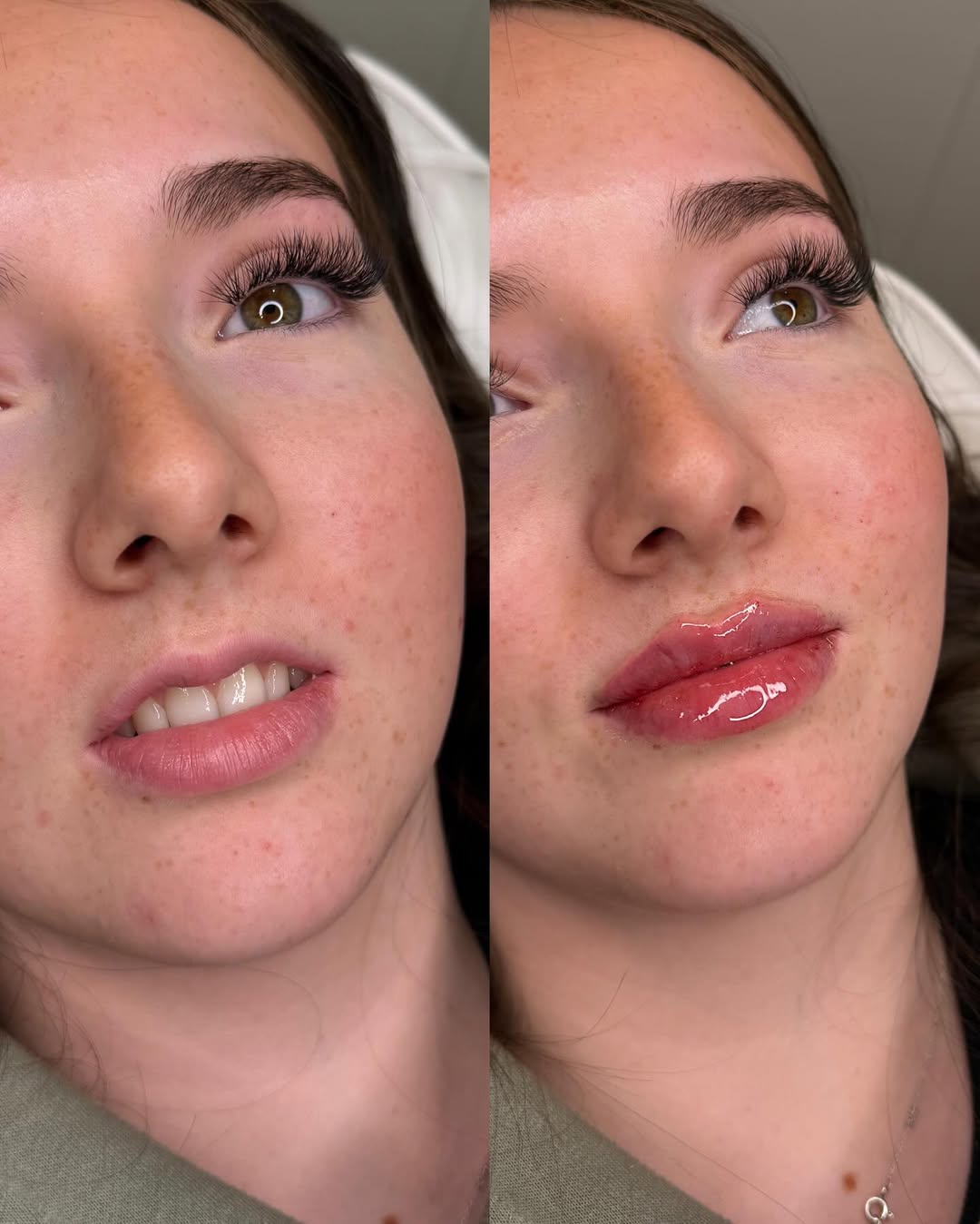 Skin Treatment Before After