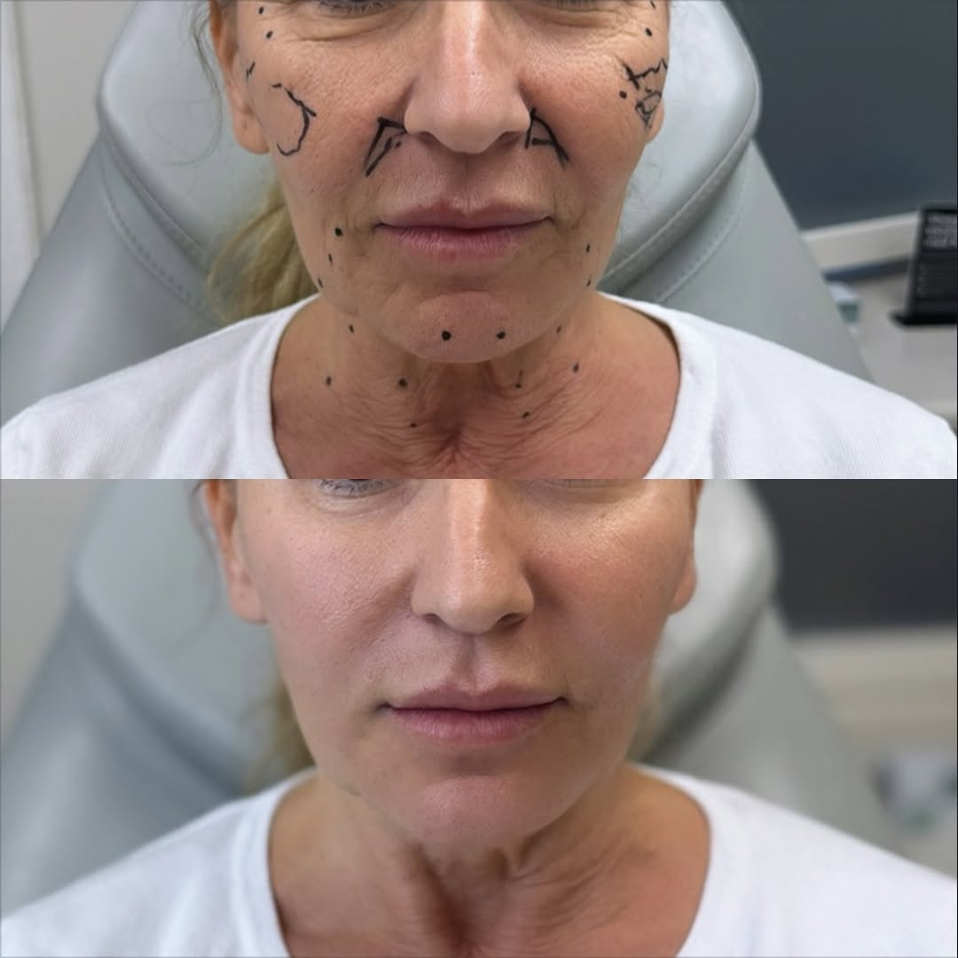 Botox Before After Dubai