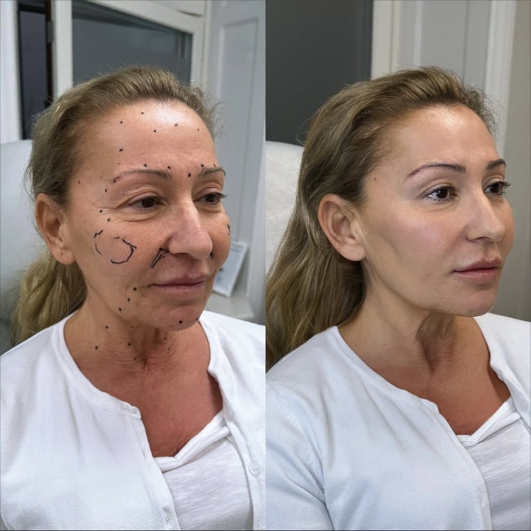 Plastic Surgery Dubai - Rhinoplasty