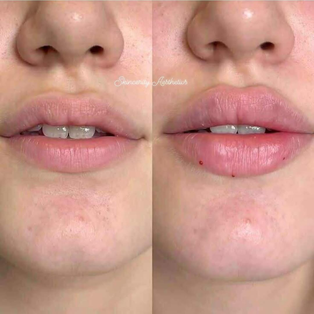 Lip Filler Results Dubai