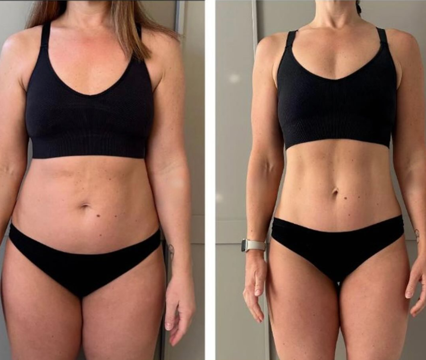 Liposuction transformation
