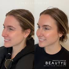Rhinoplasty transformation