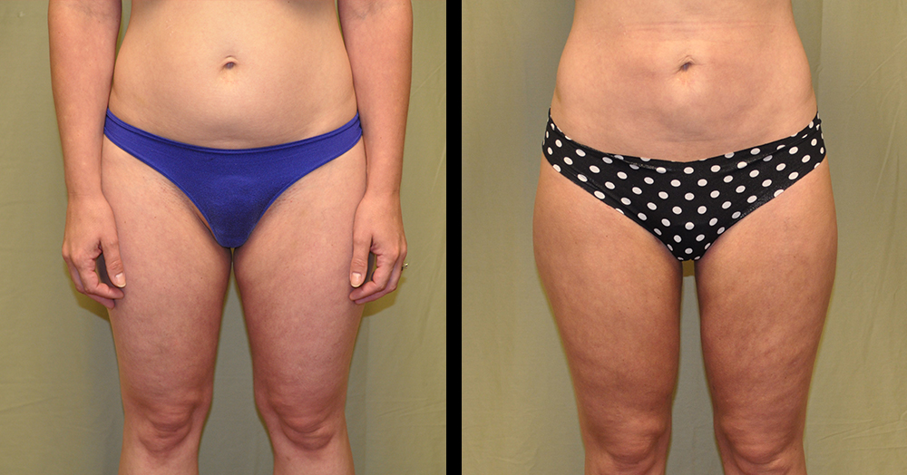 Mommy makeover transformation