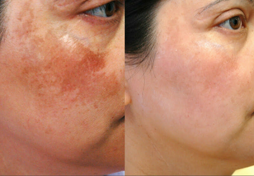 HydraFacial pigmentation treatment