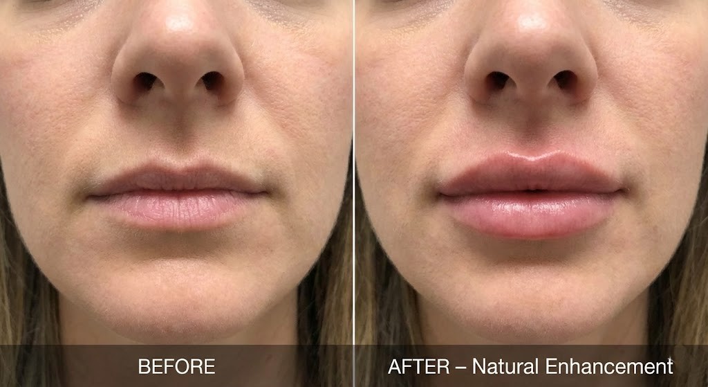 Dermal filler transformation