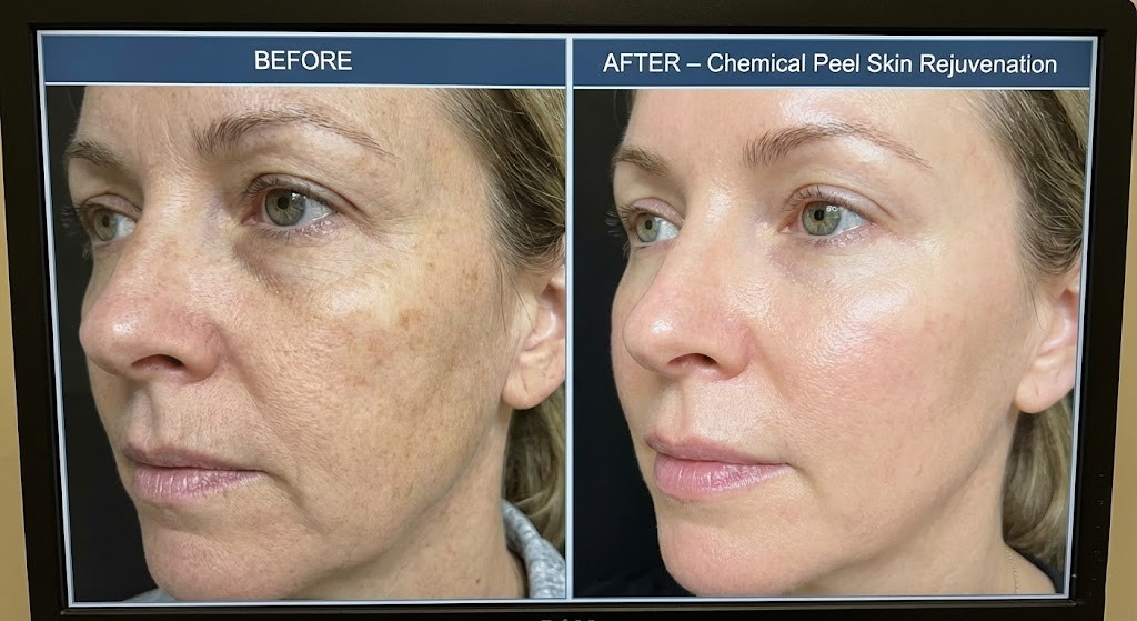 Chemical peel results