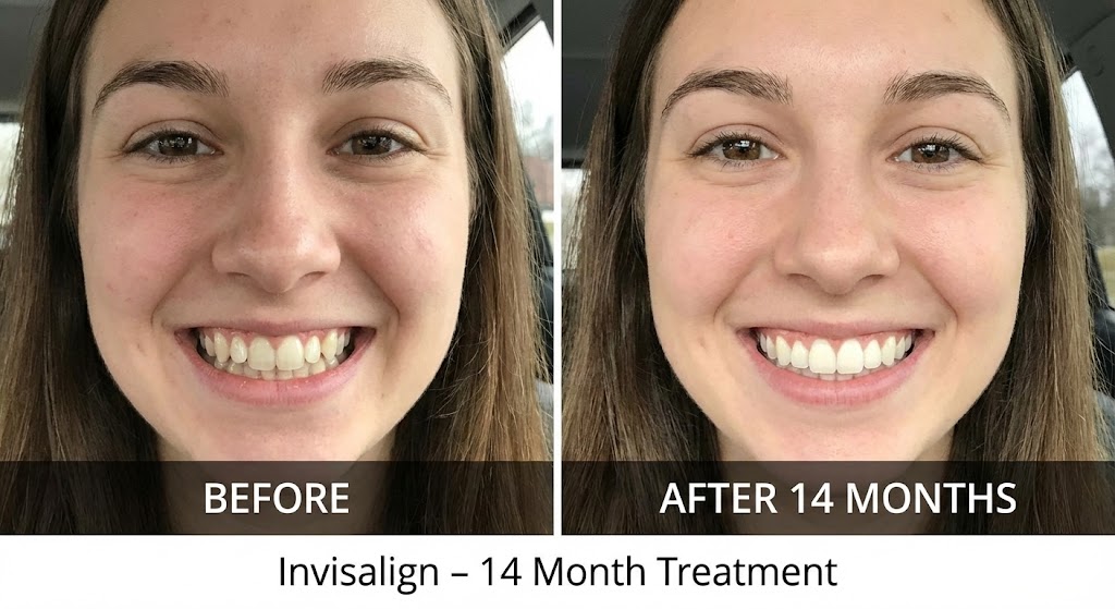 Invisalign transformation