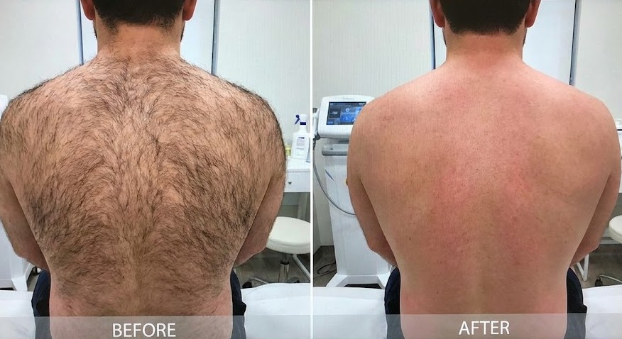 Back laser hair removal