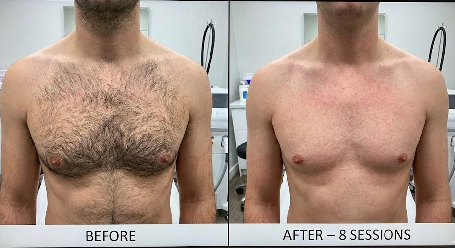 Chest laser results